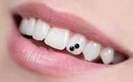 Les-bijoux-dentaires-10376